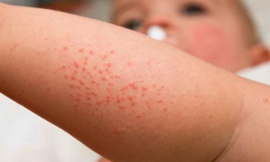 No verão, aumentam casos de dermatite atópica no país